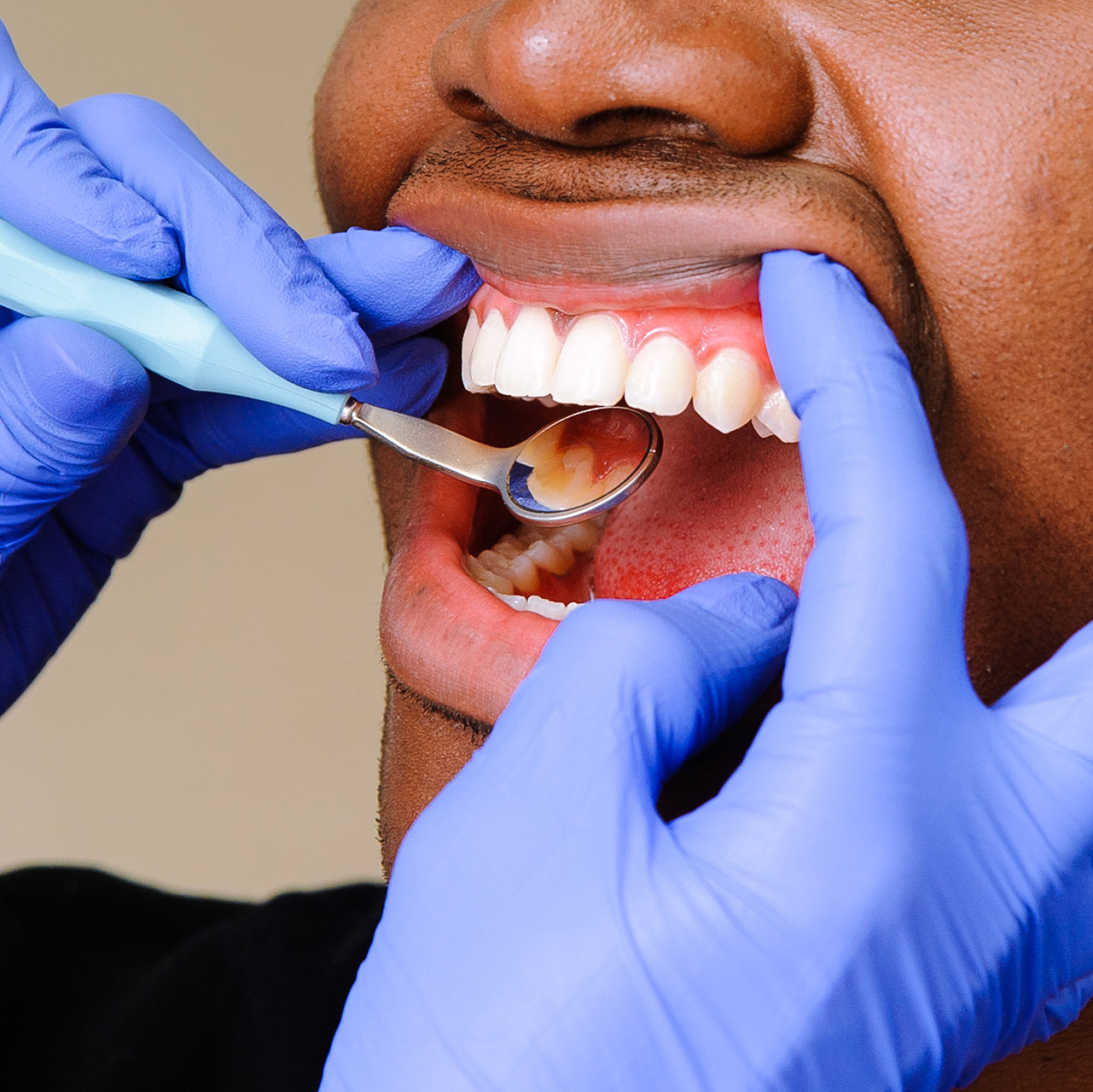 A close-up dental examination with a mouth mirror